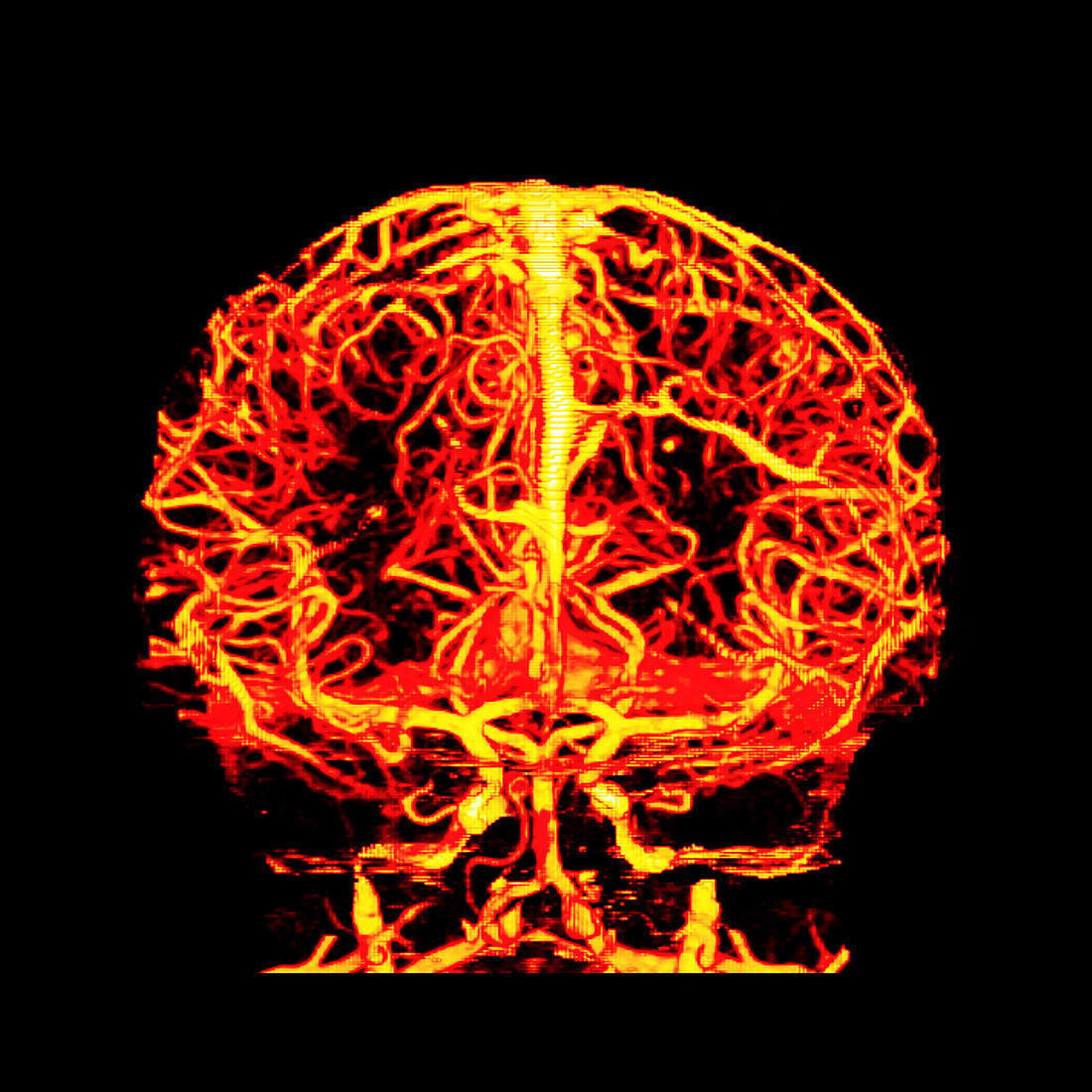 Normal Cerebral Vasculature, 3D CT Angiogram