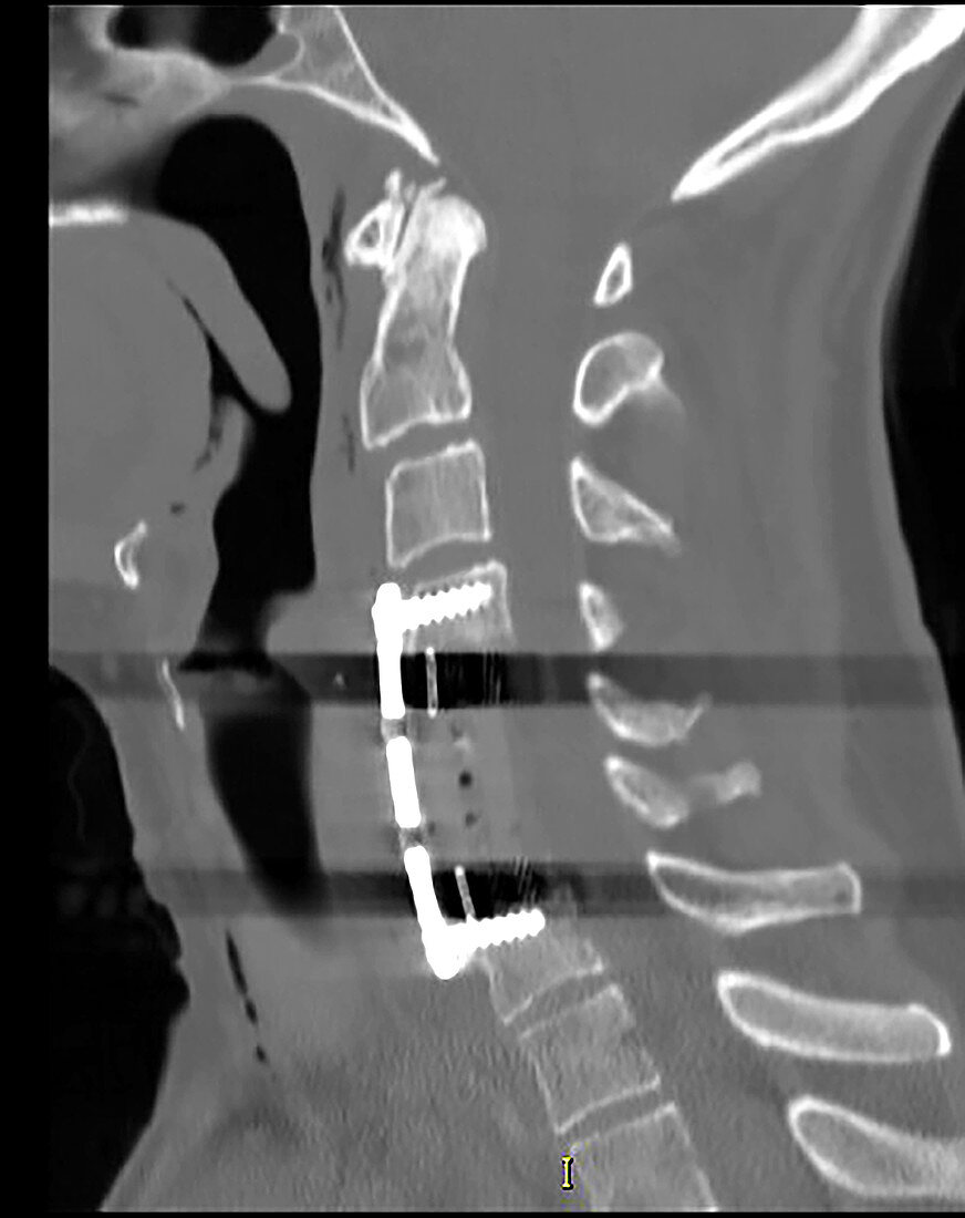 Corpectomy Cervical Spine, CT scan