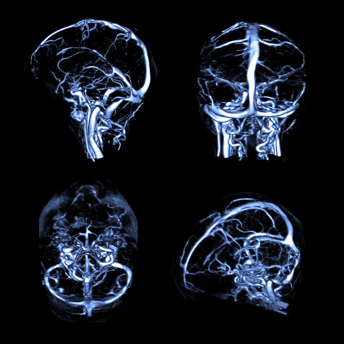 Normal Intracranial Venous System, 3D CT