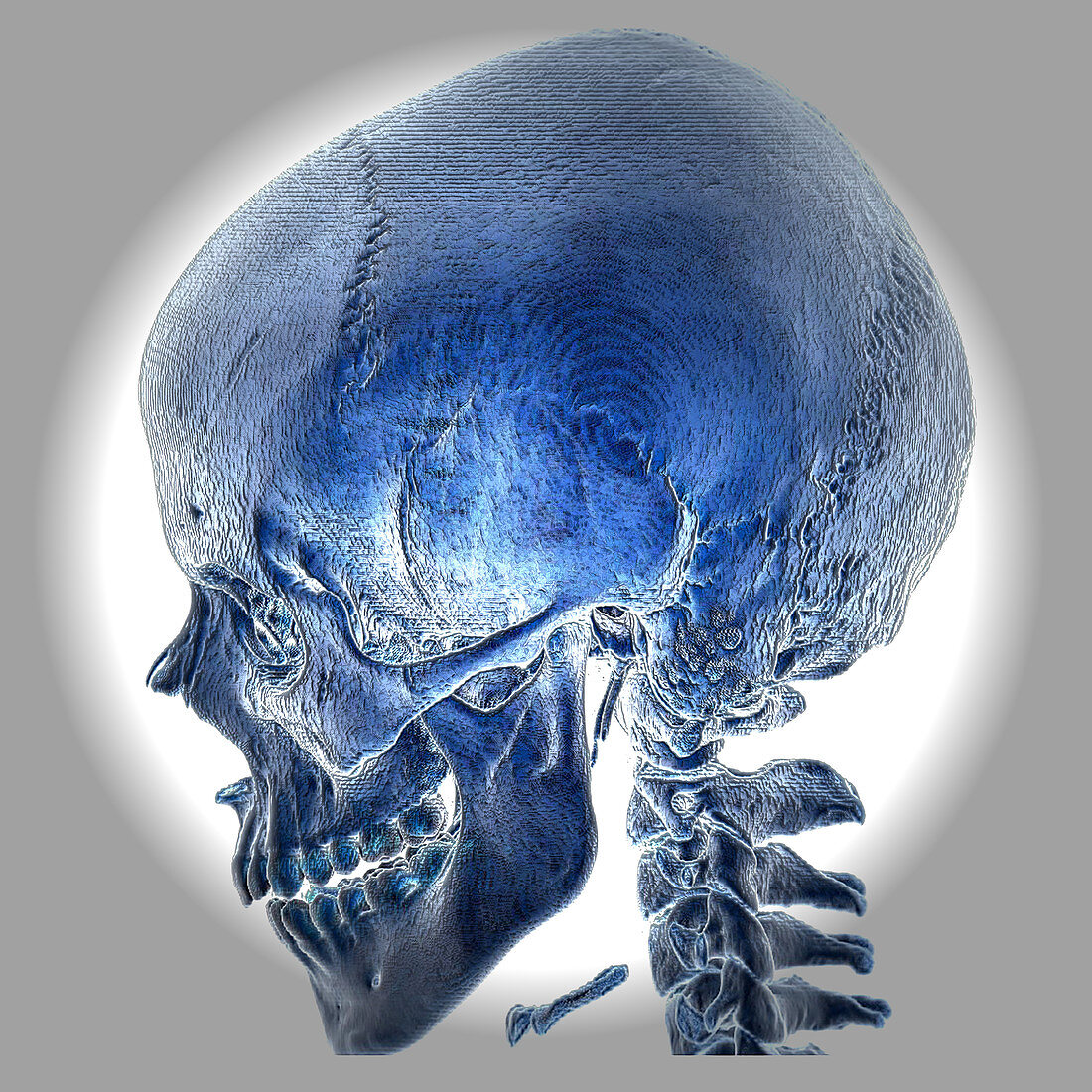 Normal Skull, 3D CT scan