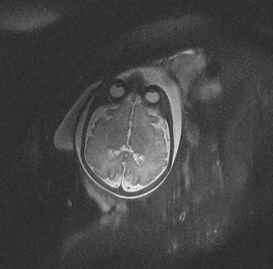 Normal Foetal Brain, MRI