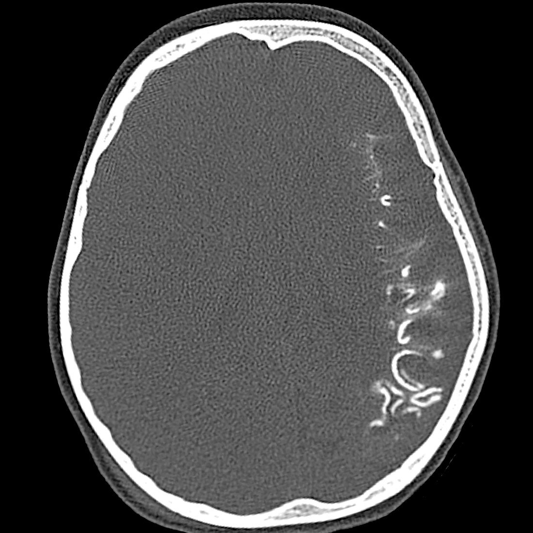 Sturge-Weber Syndrome, CT scan
