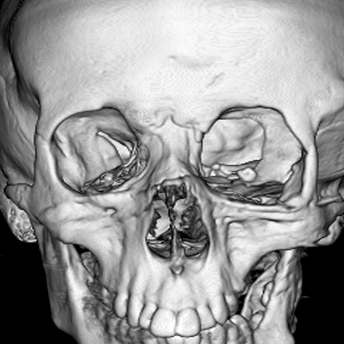Neurofibromatosis type I, 3D CT scan