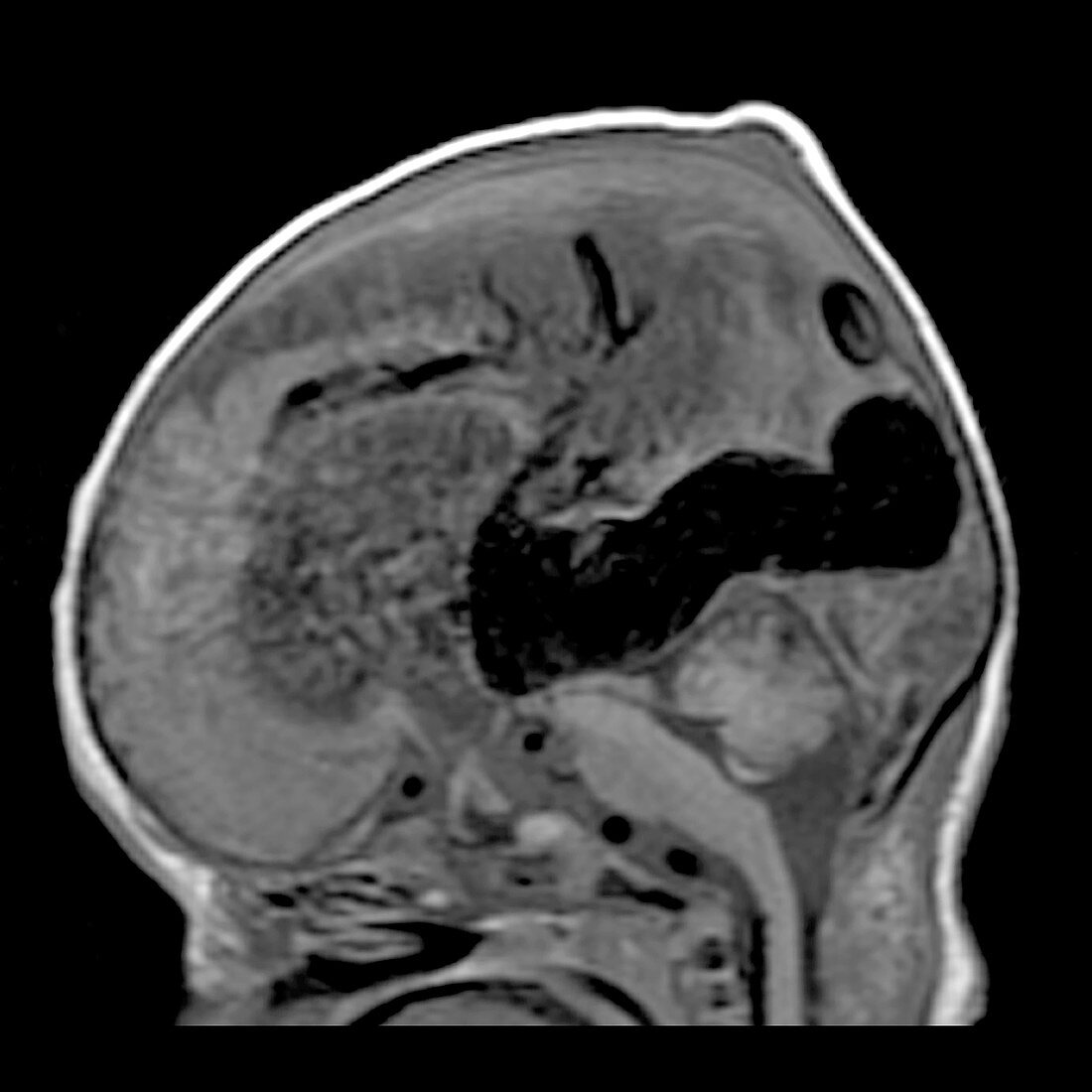 Vein of Galen Malformation, MRI