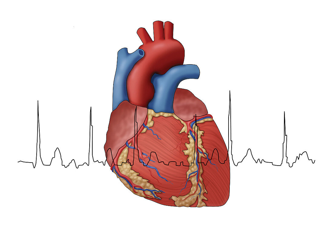 Atrial Fibrillation with EKG, Illustration