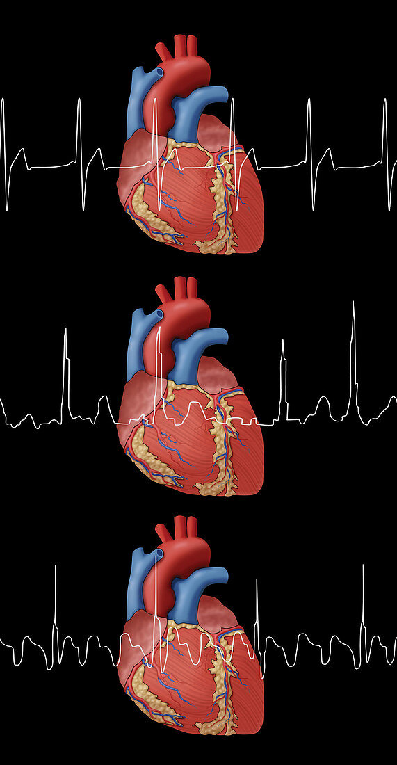 Heartbeat, AFib and Atrial Flutter, Illustration