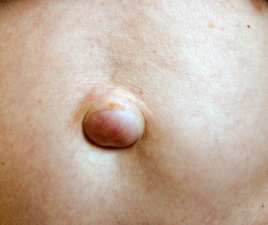 Navel hernia