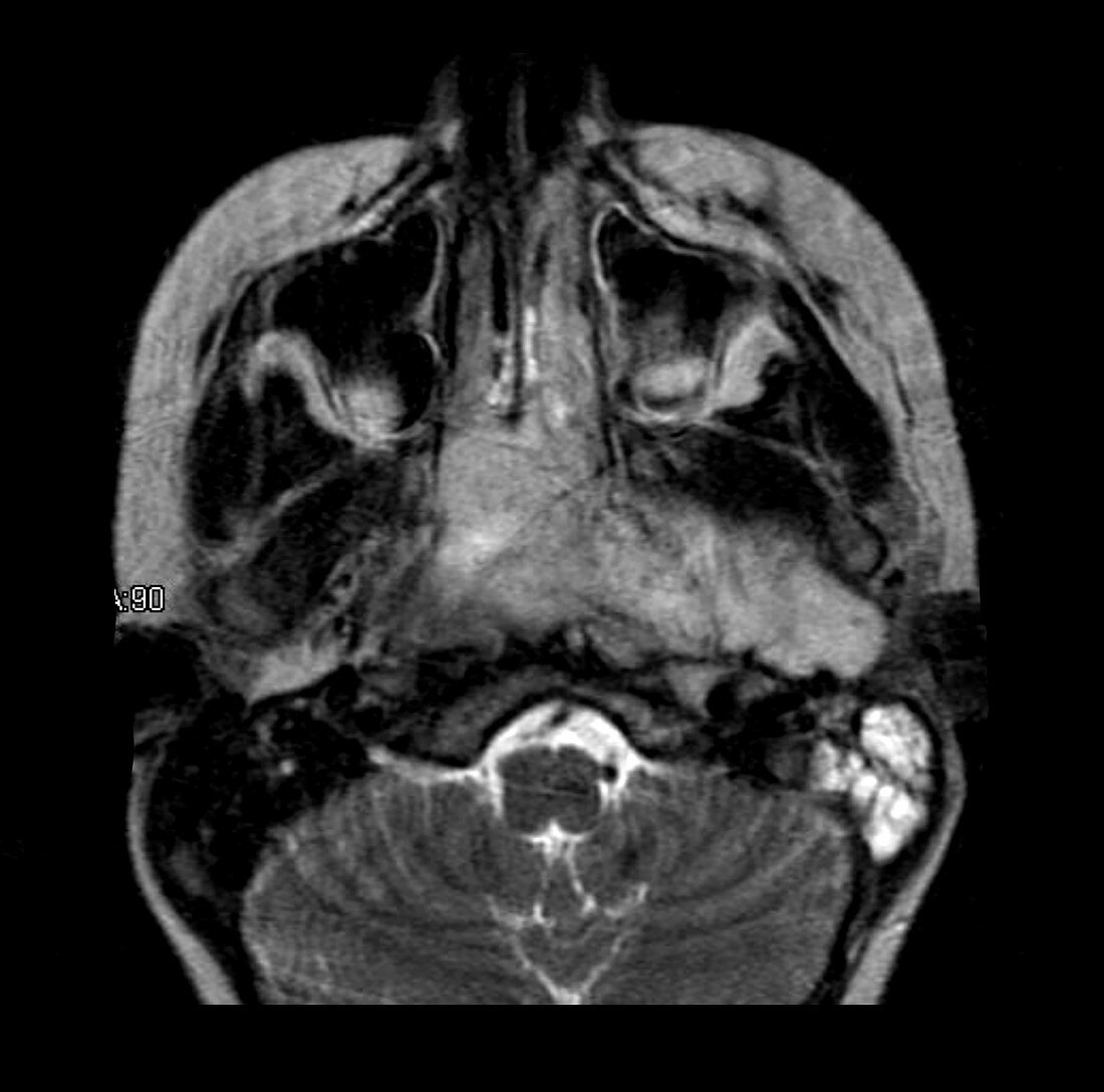 Rhabdomyosarcoma, MRI