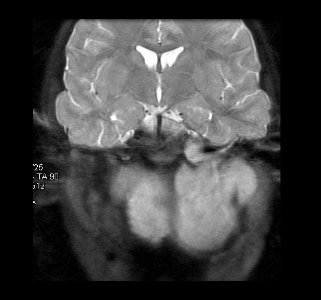 Rhabdomyosarcoma, MRI