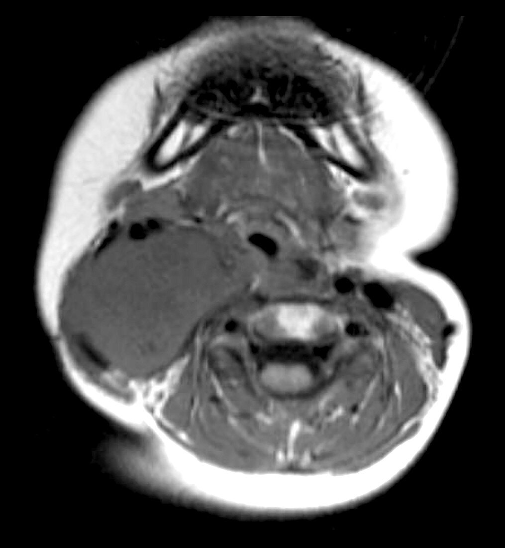 Neuroblastoma of Neck in Child, MRI