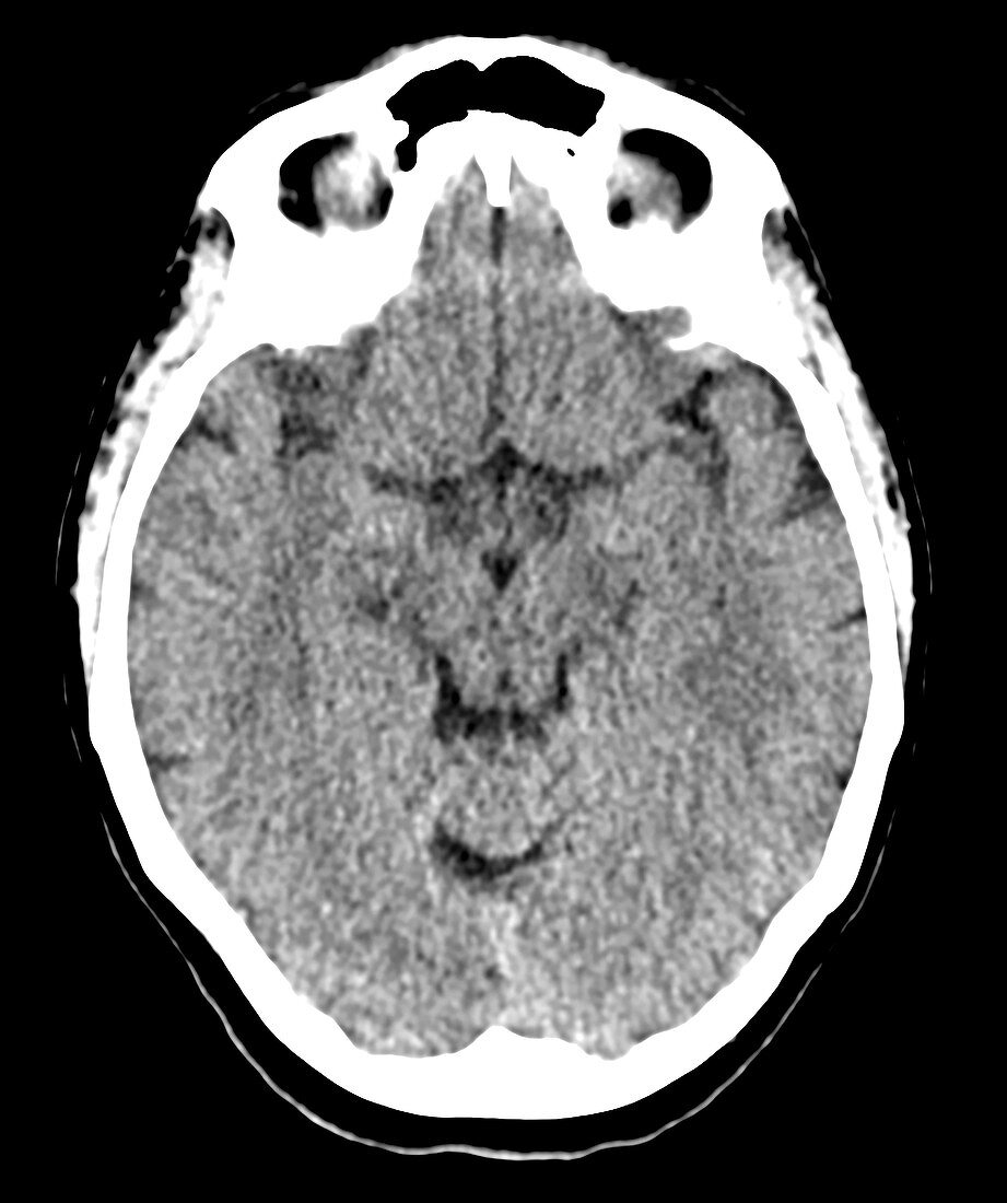 Large Developmental Venous Anomaly, CT scan