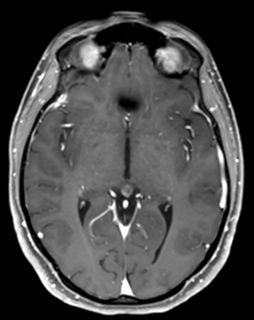 Large Developmental Venous Anomaly, MRI