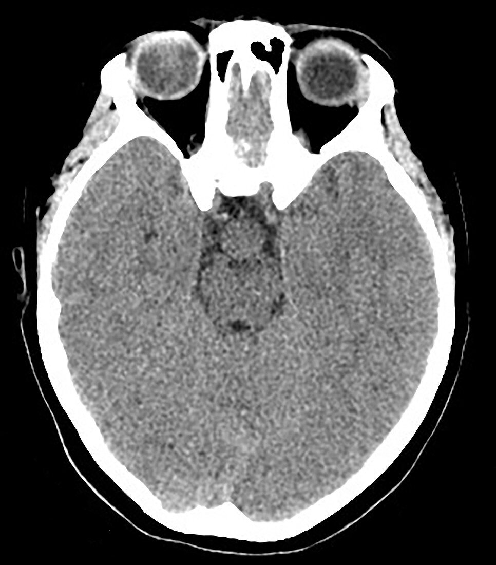 Hypothalamic Hamartoma, CT scan