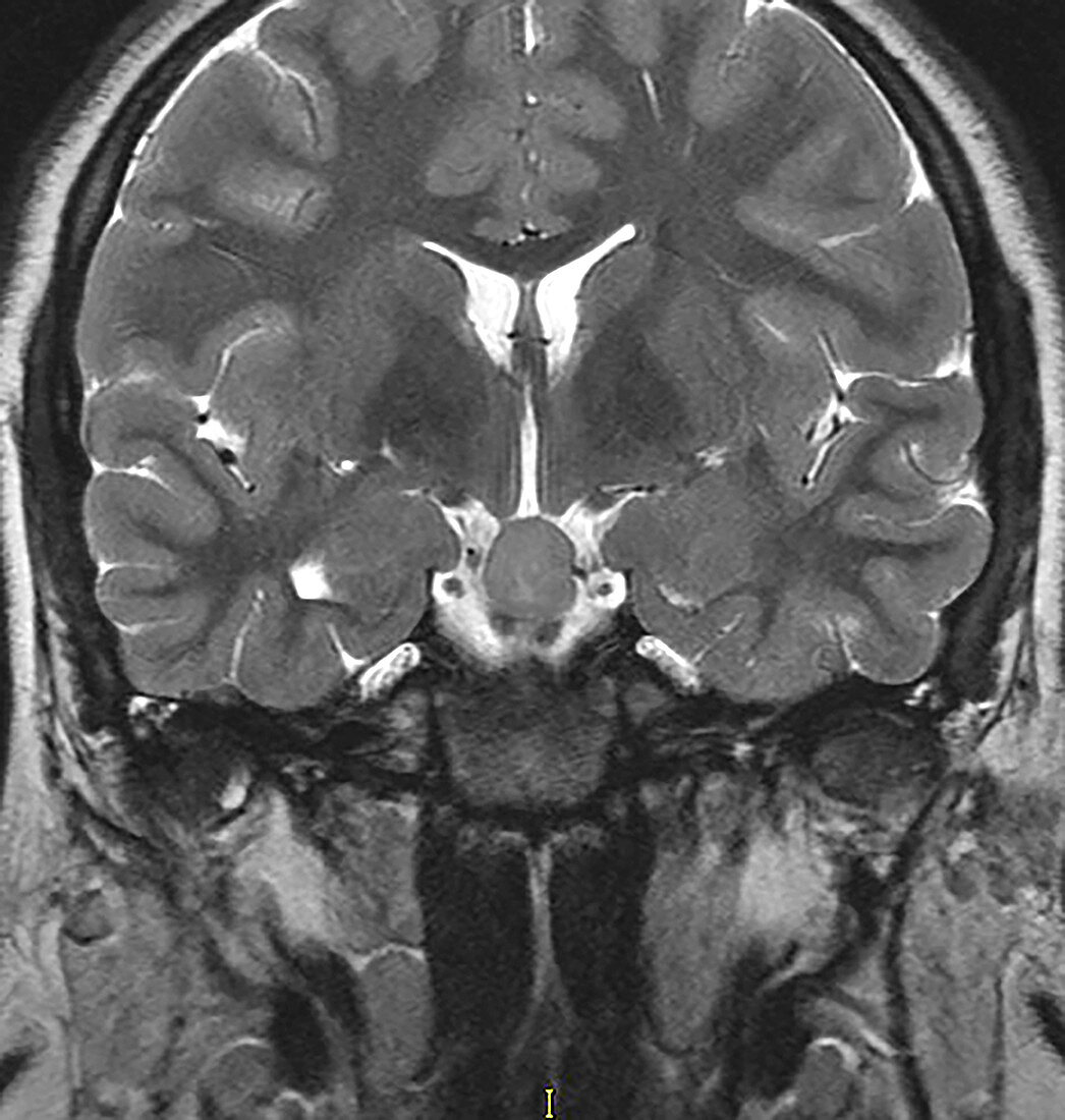 Hypothalamic Hamartoma, MRI