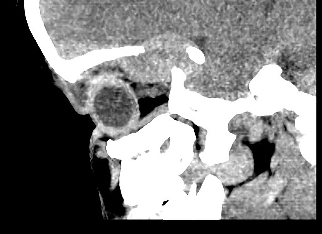 Langerhans Cell Histiocytosis, CT scan