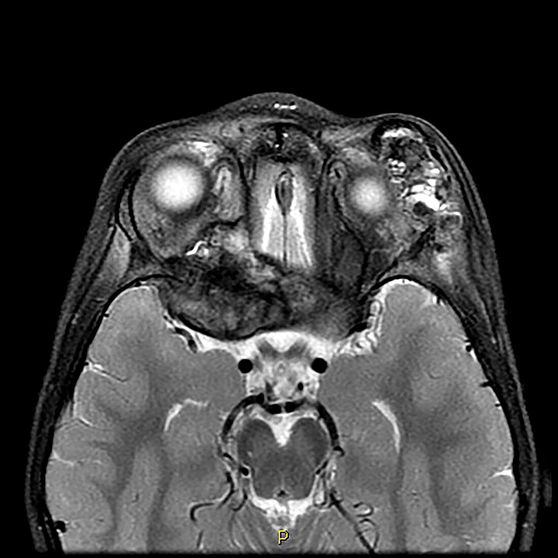 Langerhans Cell Histiocytosis, MRI