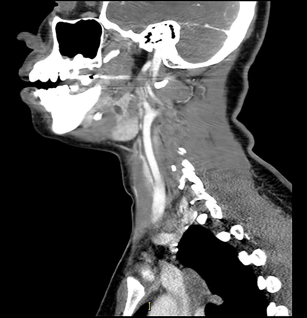 Submandibular Duct Stone, CT scan