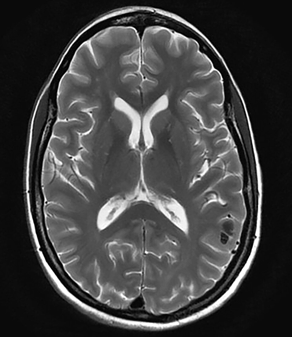 Parietal Lobe AVM, MRI