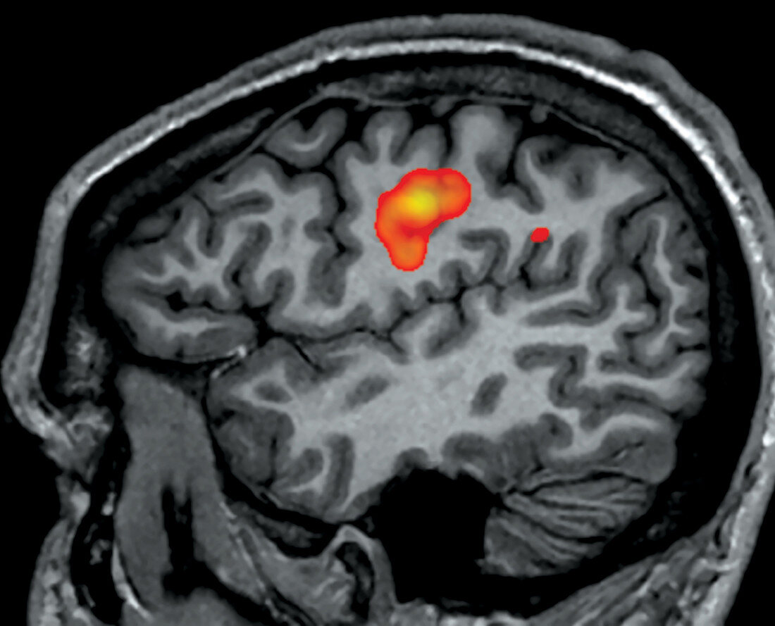 fMRI during Facial Grimacing