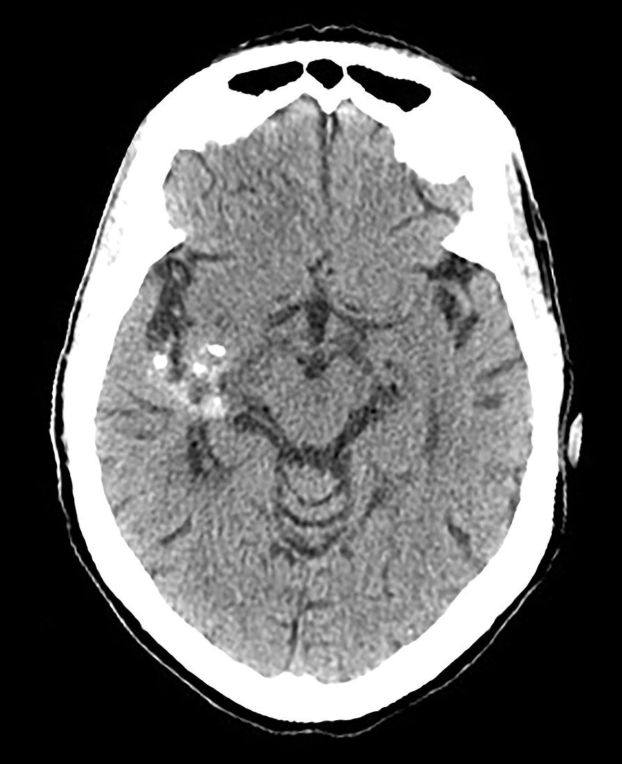 Intracranial Cavernous Malformation, CT scan