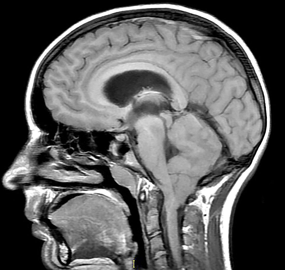 Cerebellar Hemangioblastoma, MRI