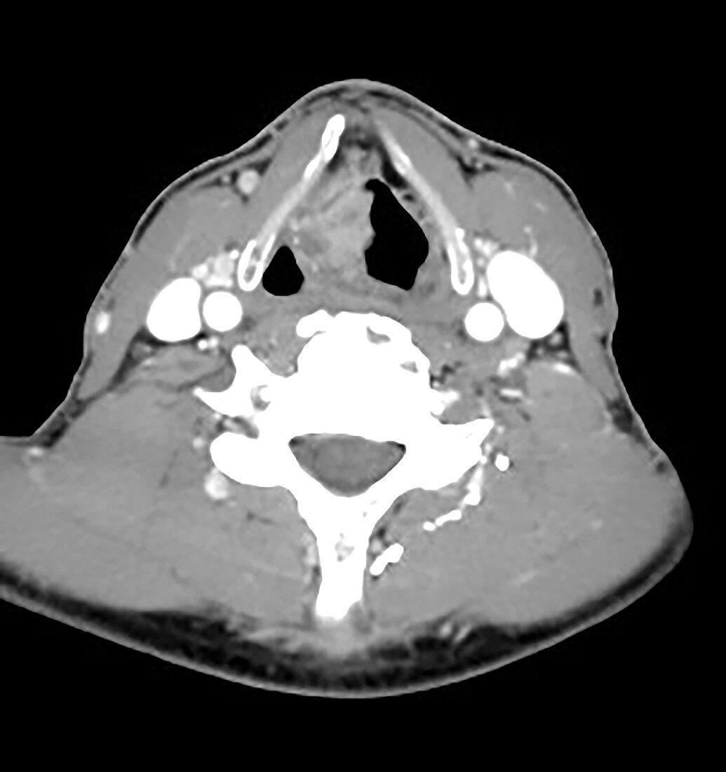 Transglottic Squamous Cell Carcinoma, CT scan