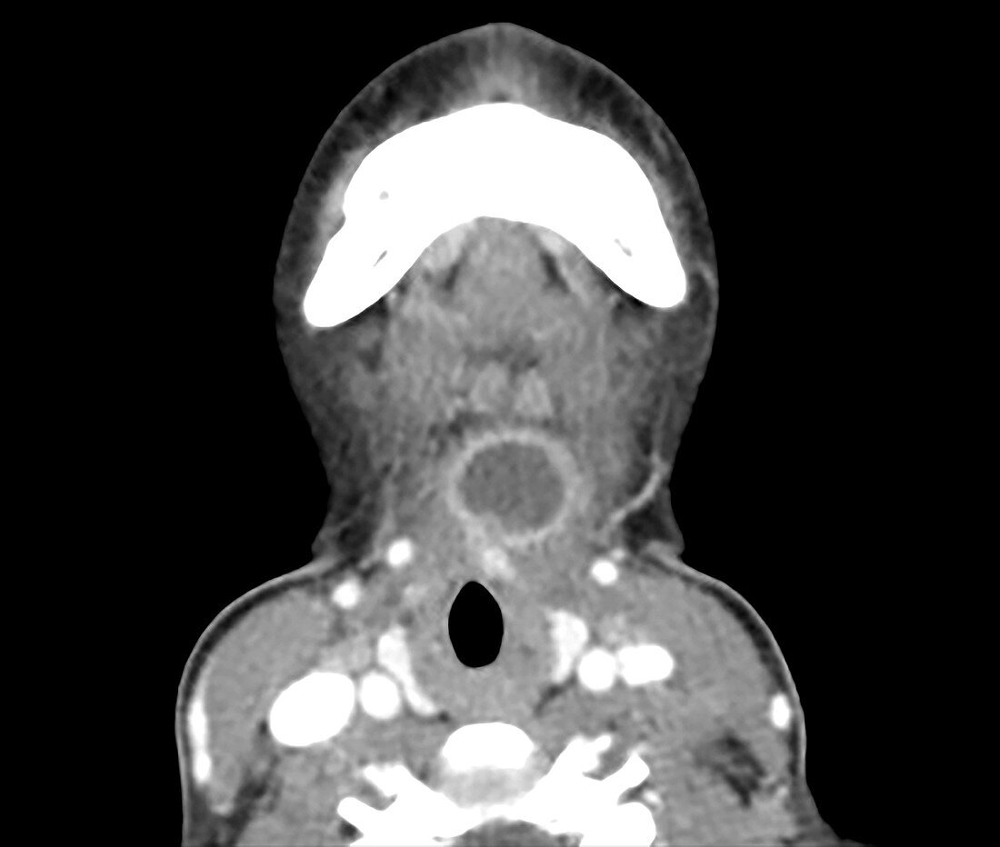 Infected Thyroglossal Duct Cyst, CT scan