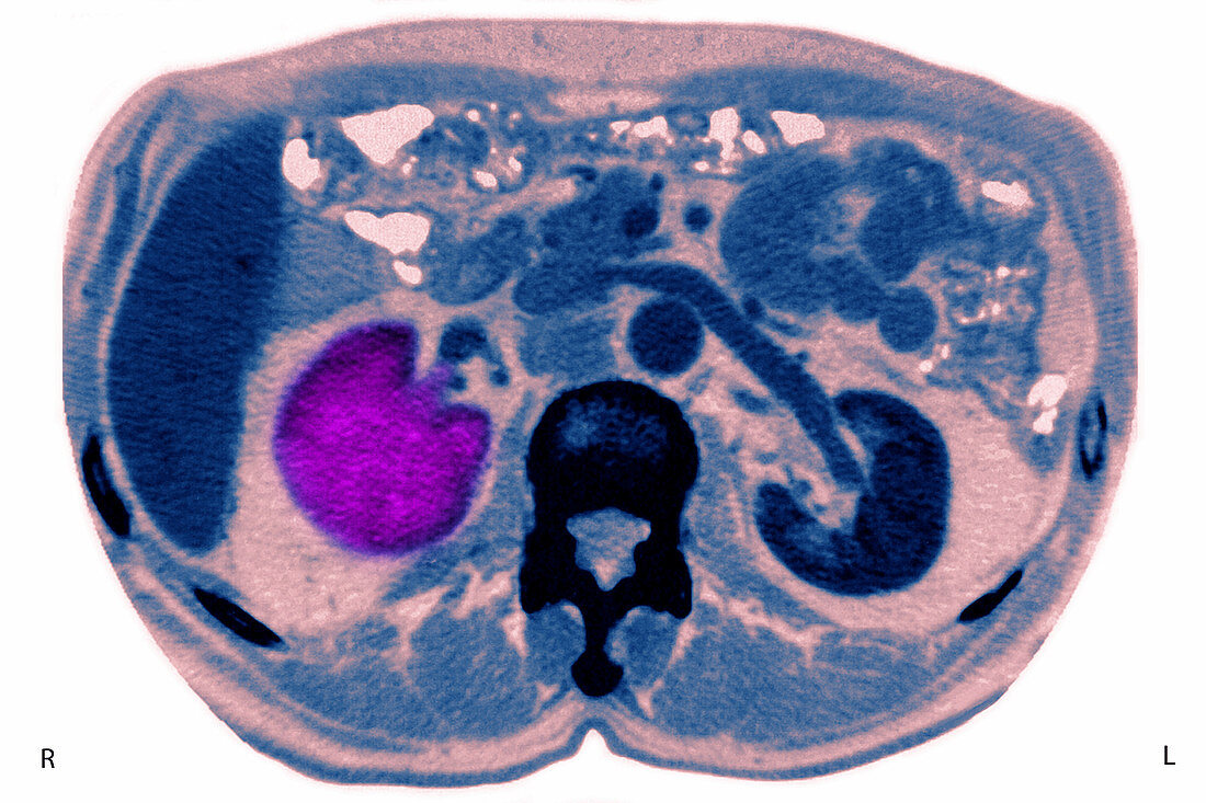 Renal Cancer, CT Scan