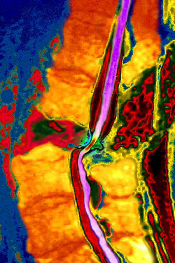 Lumbar Vertebrae Dislocation, MRI