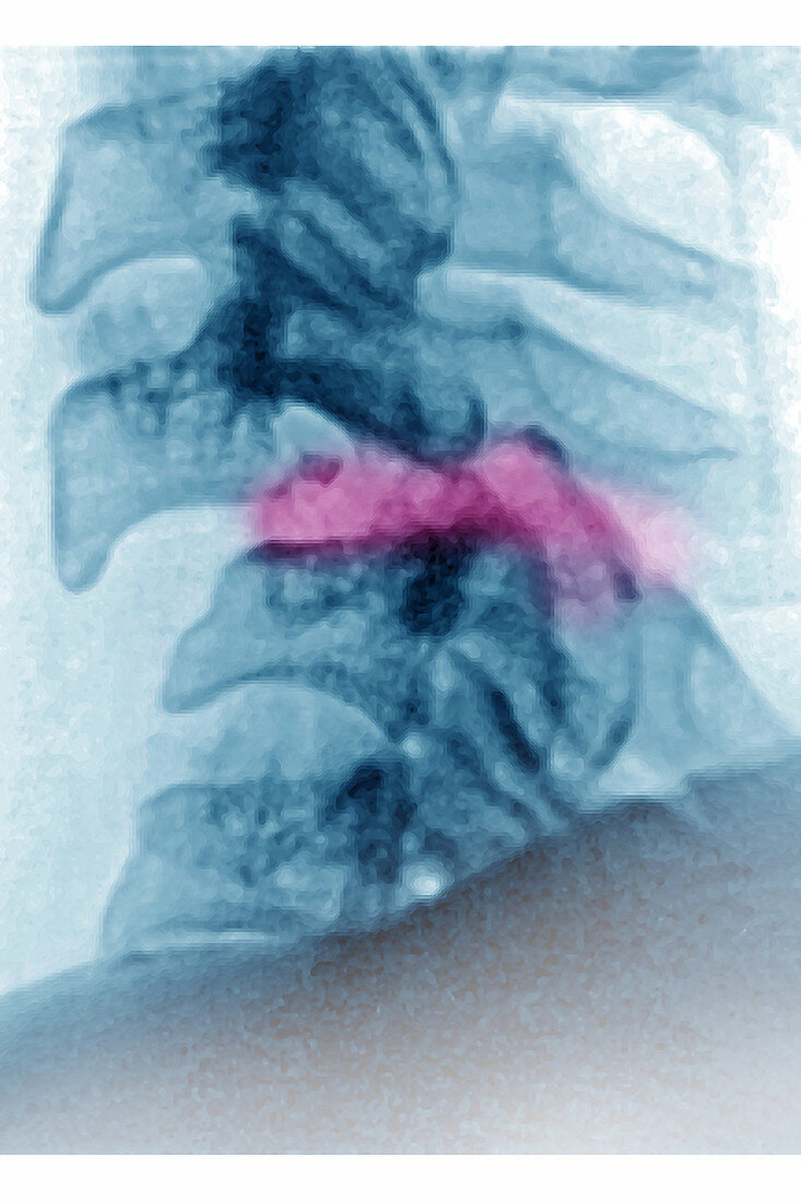 Cervical Vertebrae Dislocation, X-ray