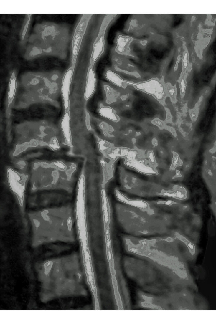 Cervical Vertebrae Dislocation, MRI