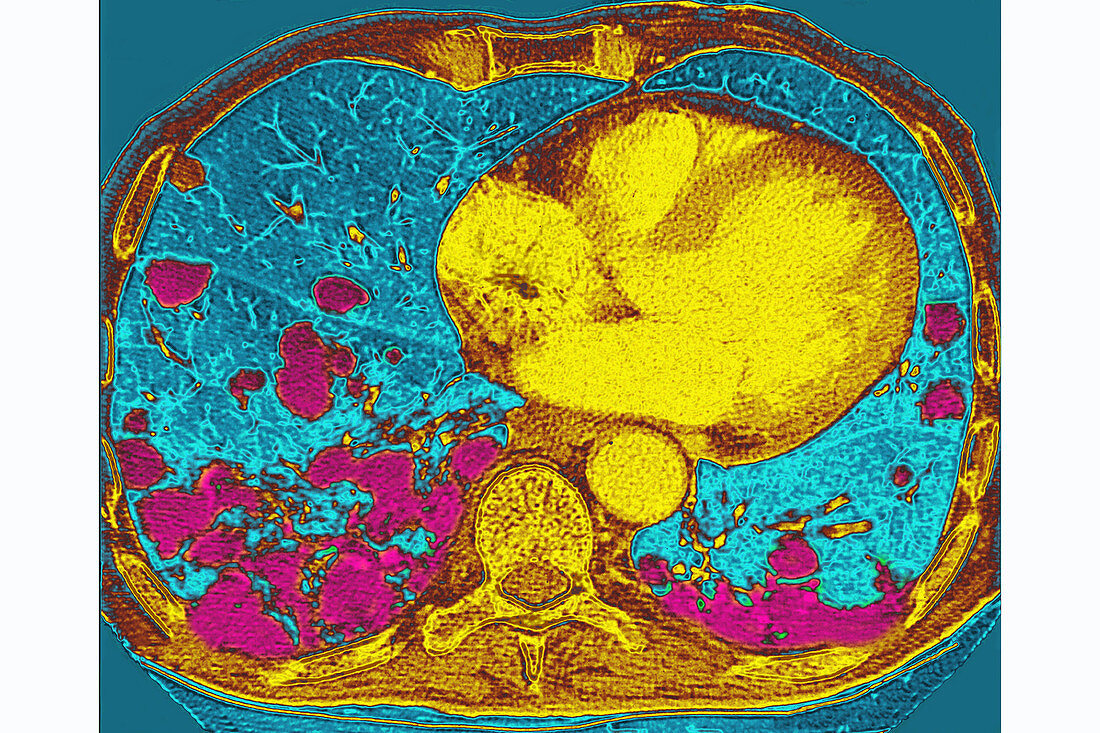 Lung Metastases, CT Scan