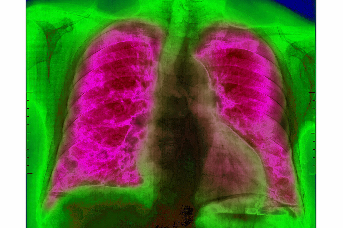 Lung Metastases, X-ray