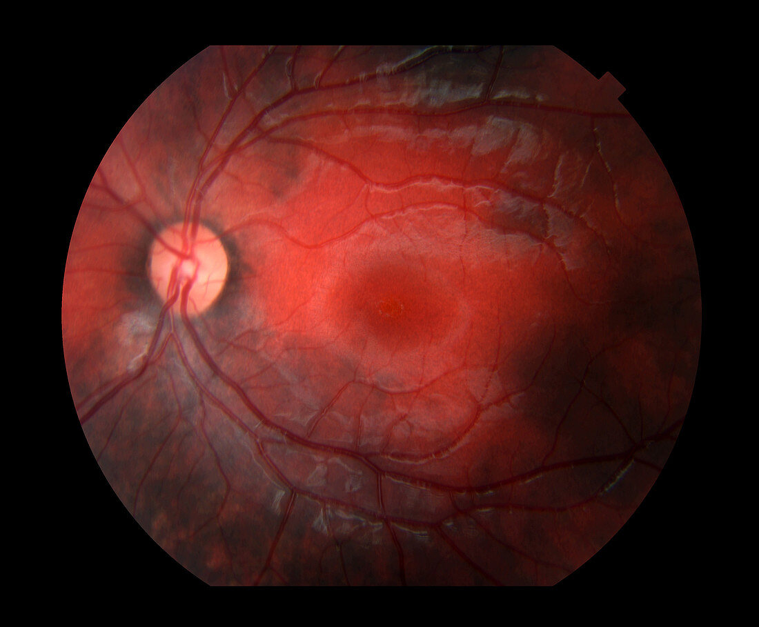 Bilateral Melanosis of Eye