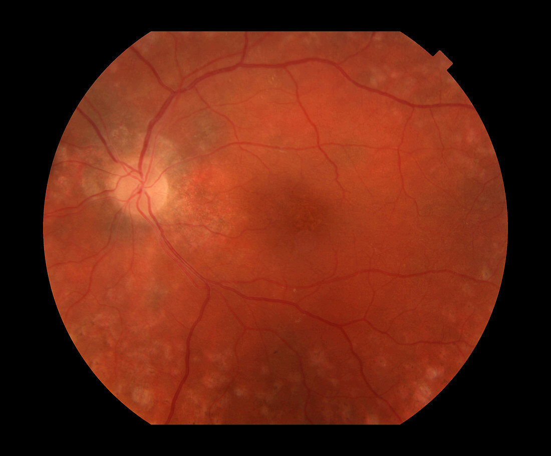 Metastatic Melanoma in Eye