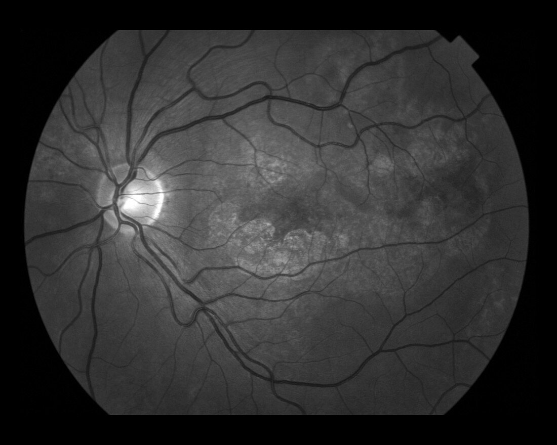 Uveitis Scars