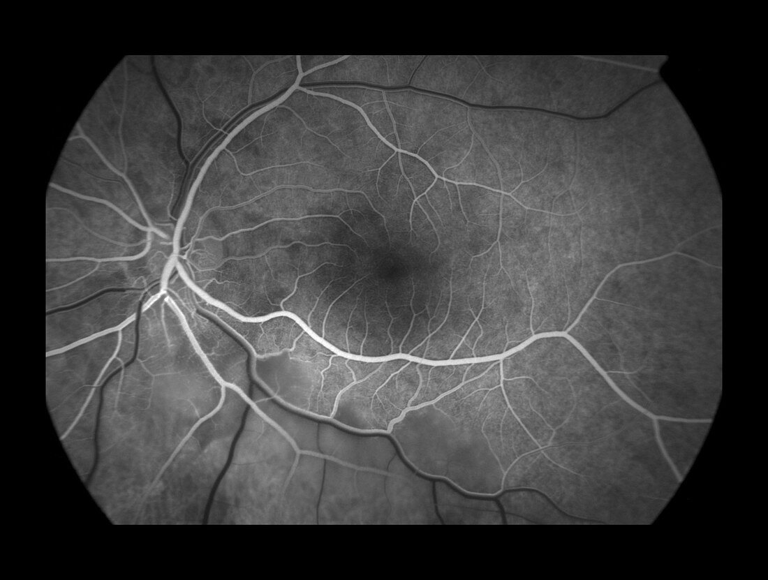 Branch Retinal Artery Occlusion, 3 of 5