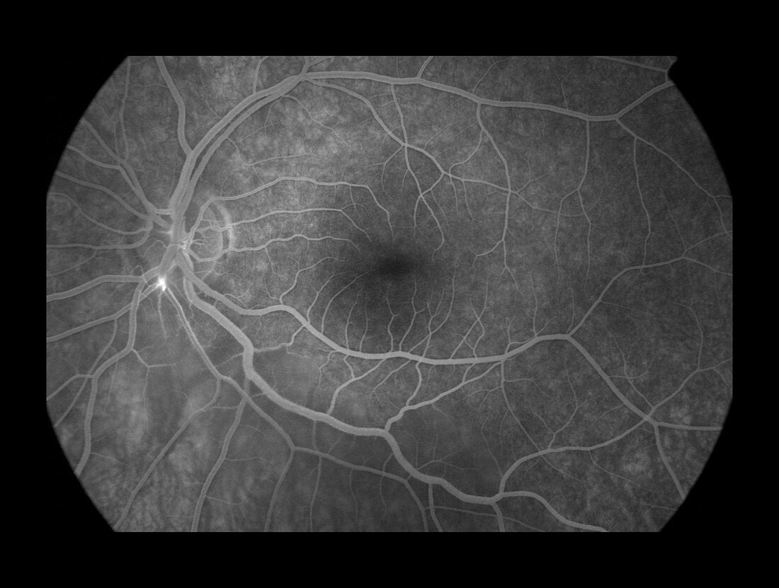 Branch Retinal Artery Occlusion, 5 of 5