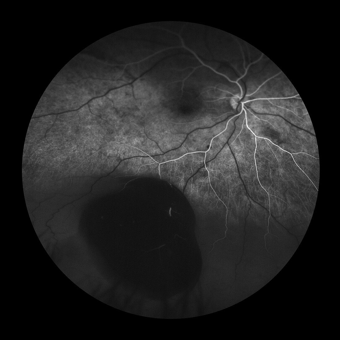 Choroidal Melanoma, 2 of 8