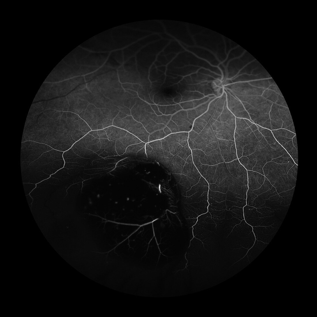 Choroidal Melanoma, 4 of 8