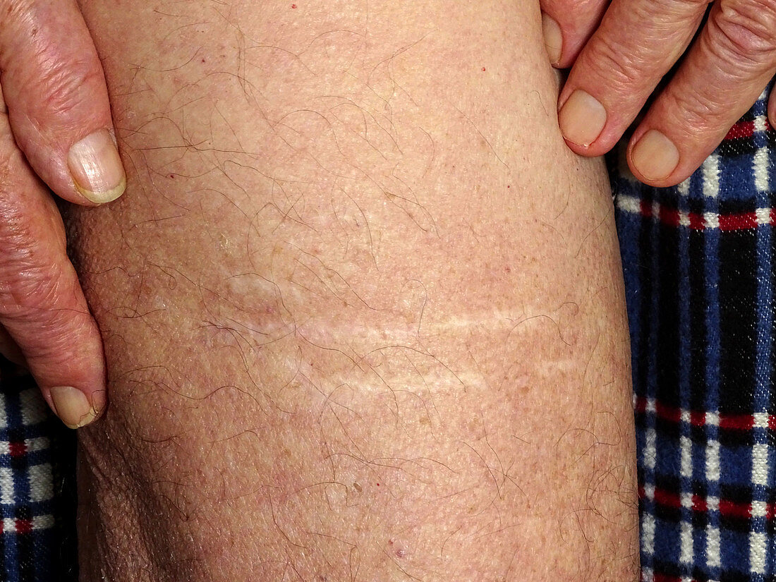 Scars after fire coral injury