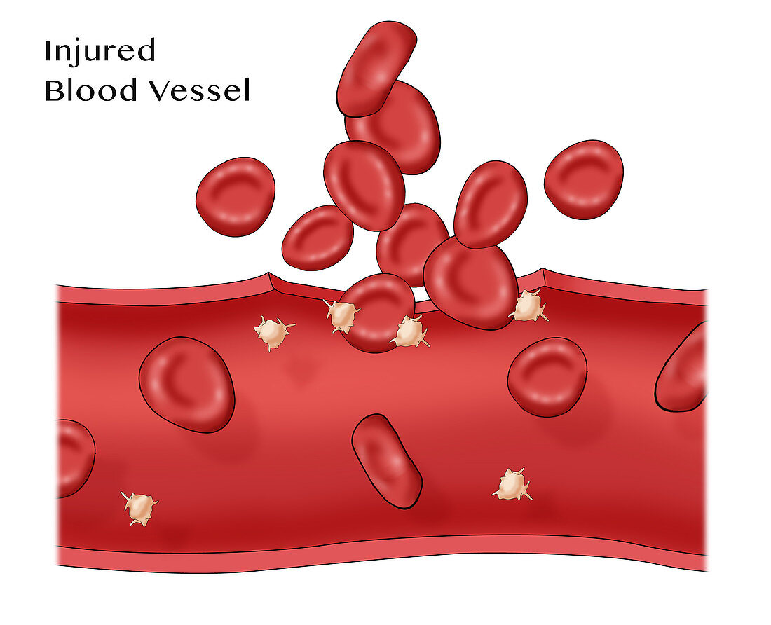 Blood clot