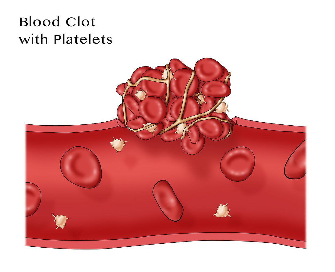 Blood clot