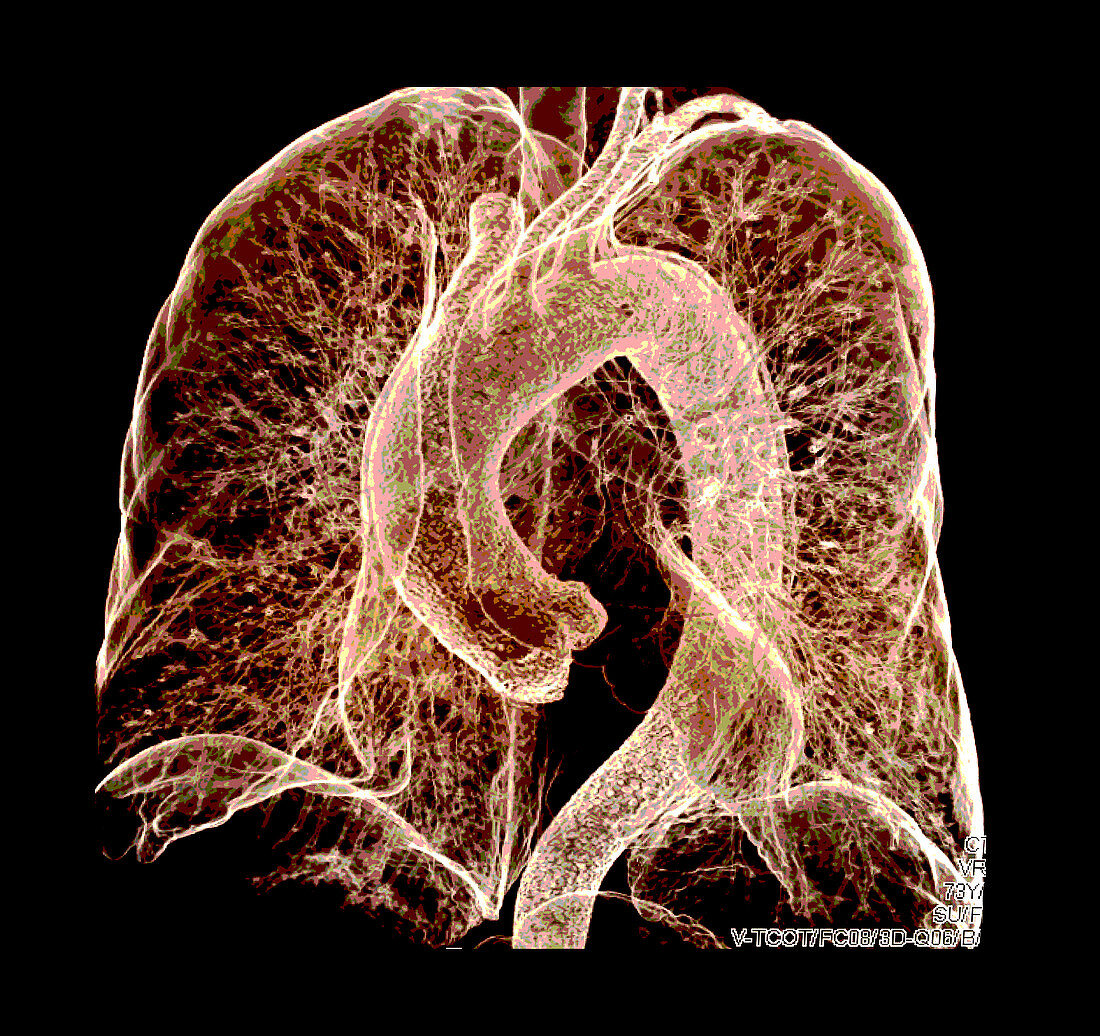 Enhanced Multidetector CT of Chest