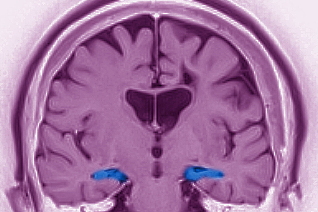 Alzheimer's Disease, MRI