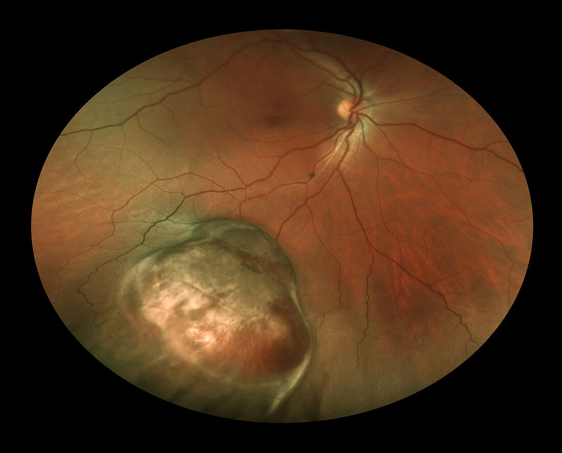 Choroidal Melanoma