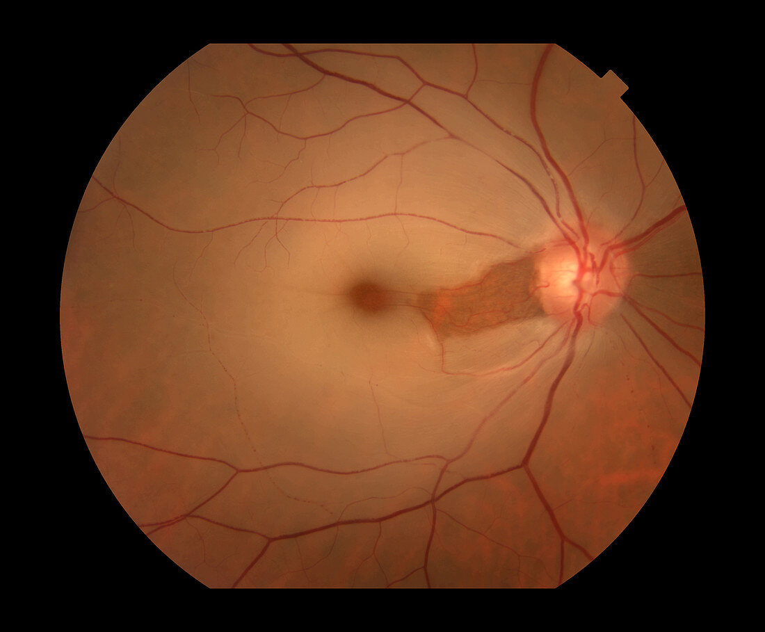 CRAO With Cilioretinal Artery