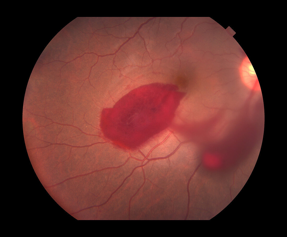 Subhyaloid Haemorrhage