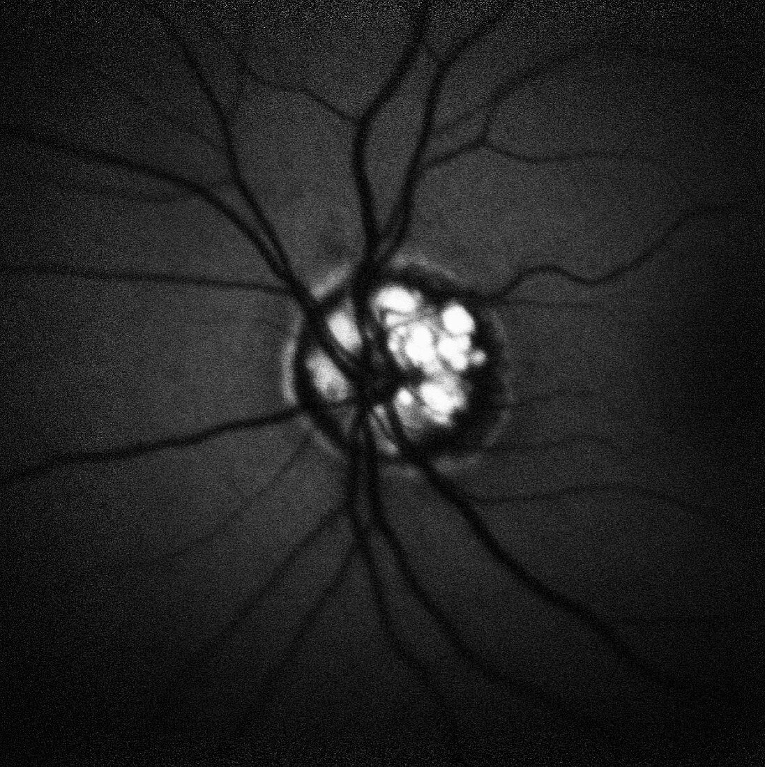 Optic Nerve Head Druzen