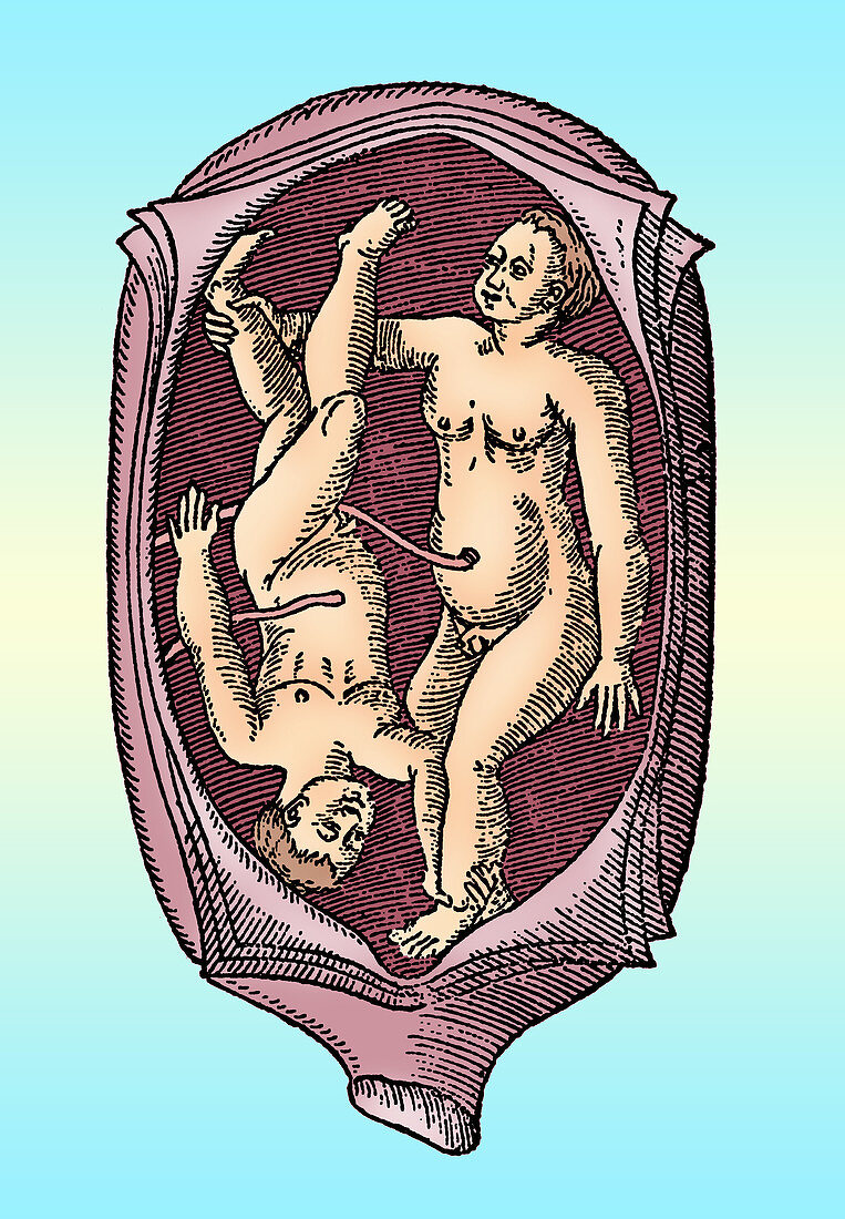 Abnormal Fetal Presentation, 16th Century
